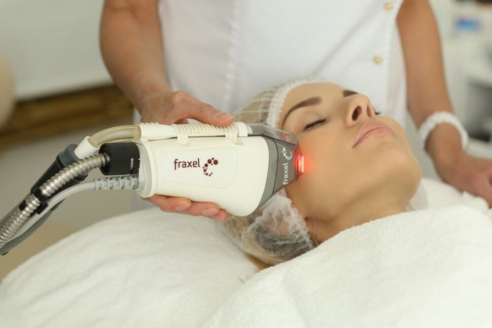 Laserverjonging