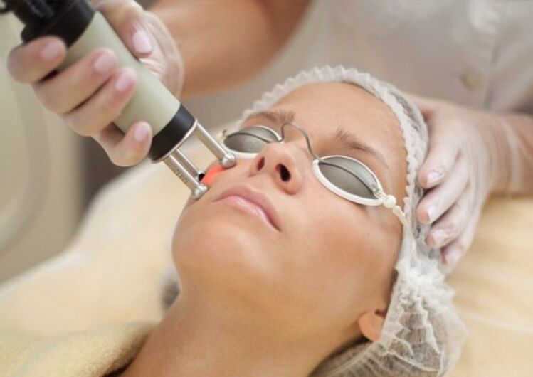 Veldlaser Verjongingsprocedure