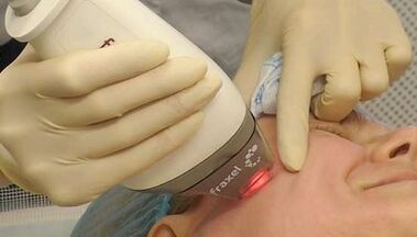 Hoe wordt fractionele huidverjonging uitgevoerd