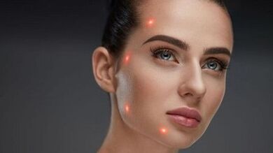 Wat is fractionele huidverjonging