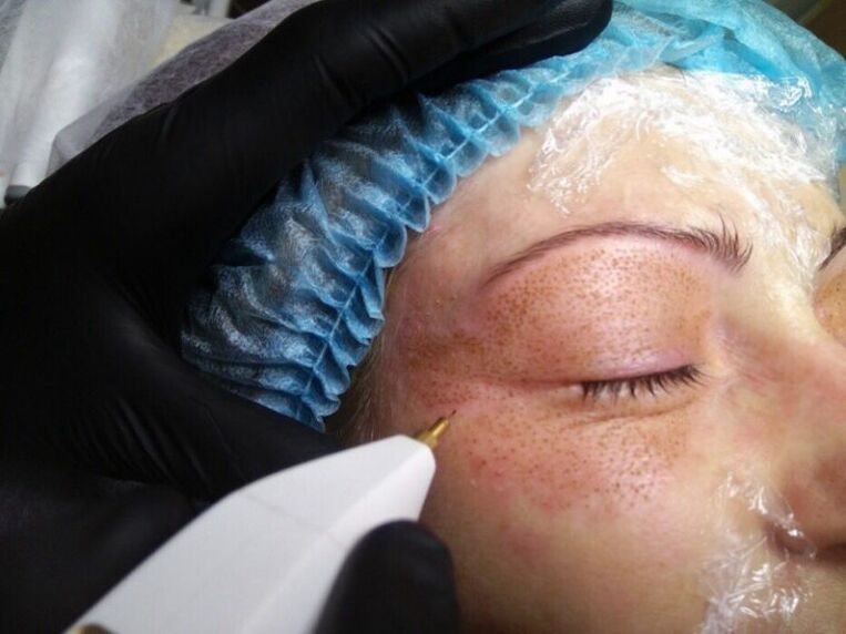 Plasma-liftprocedure