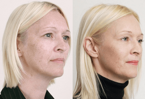 Medium peeling met fruitzuren