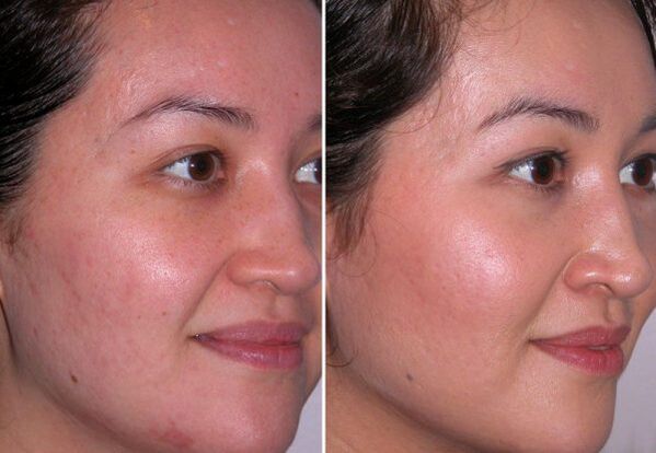 cursus microdermabrasie