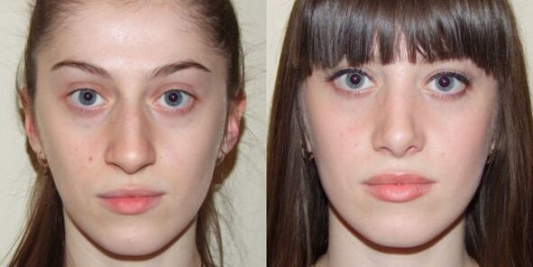 Meisje voor en na plasma-gezichtshuidverjonging