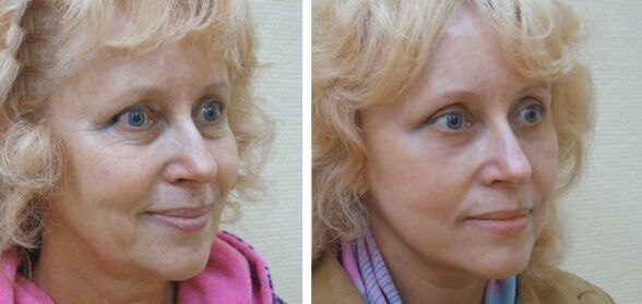 Vrouw voor en na plasma-gezichtshuidverjonging